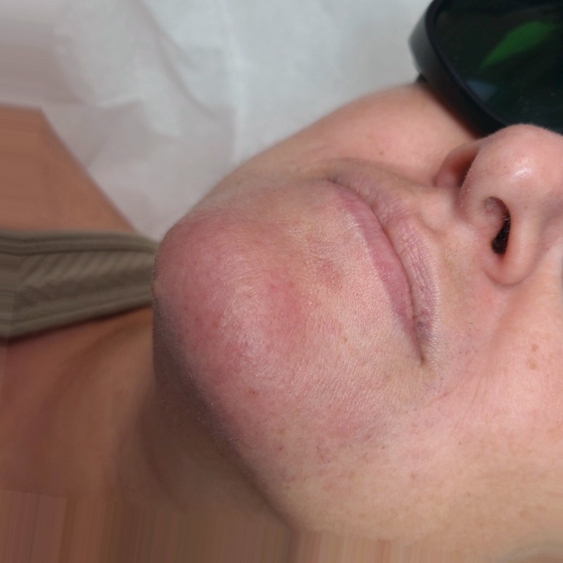 Lower Face