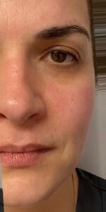 After: Face — before & after