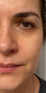 Before: Face — before & after