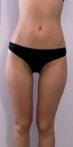 After: Body — before & after