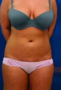 After treatment — body