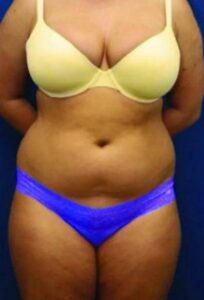 Before treatment — body