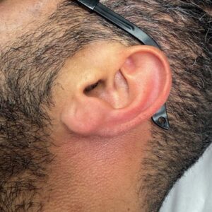 After treatment — ears