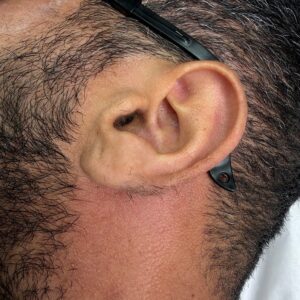 Before treatment — ears