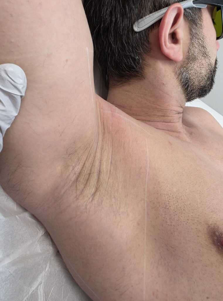 After treatment — underarms