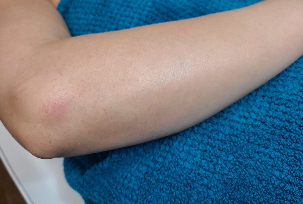 After treatment — arms