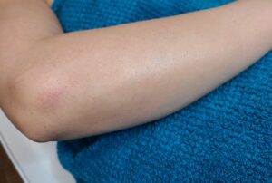 After treatment — arms