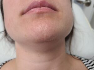 After treatment — chin & neck