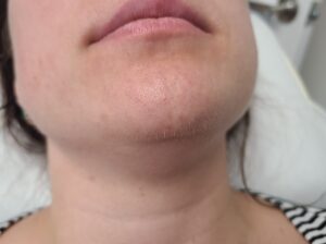 Before treatment — chin & neck