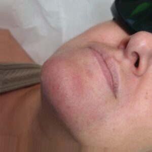 After treatment — chin & neck