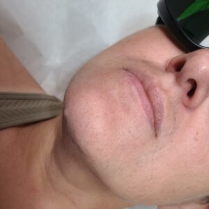 Before treatment — chin & neck