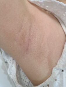 After treatment — underarms
