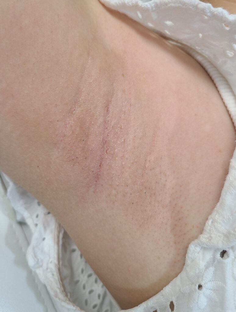 After treatment — underarms