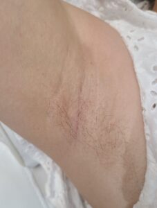 Before treatment — underarms