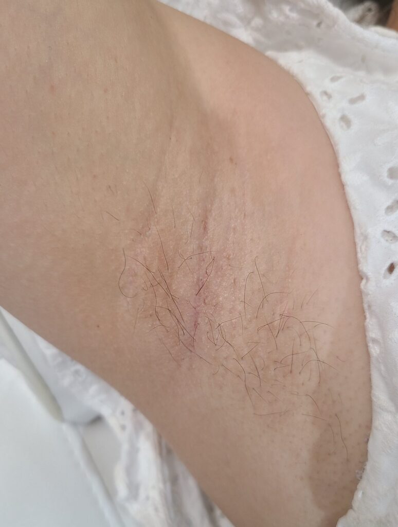 Before treatment — underarms