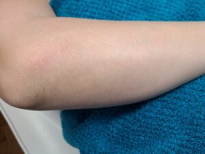 After treatment — arms