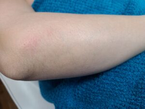 Before treatment — arms