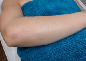 After treatment — arms
