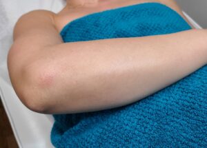 Before treatment — arms