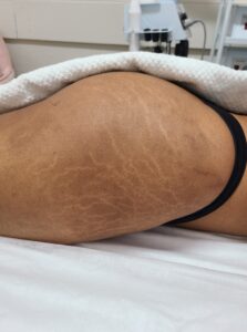 After treatment — legs