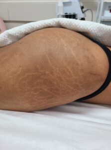 Before treatment — legs