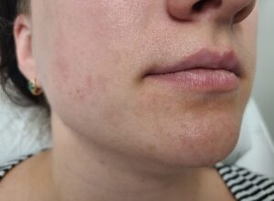 After treatment — chin & neck