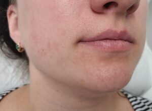 Before treatment — chin & neck