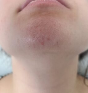 After treatment — chin & neck