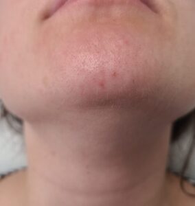 Before treatment — chin & neck