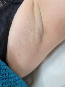 After treatment — underarms