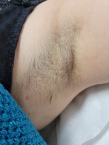 Before treatment — underarms