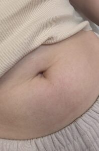 After treatment — stomach