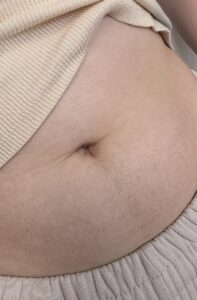 Before treatment — stomach