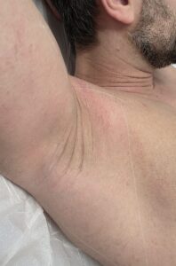 After treatment — underarms