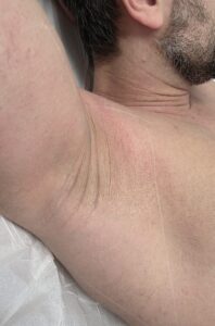 Before treatment — underarms
